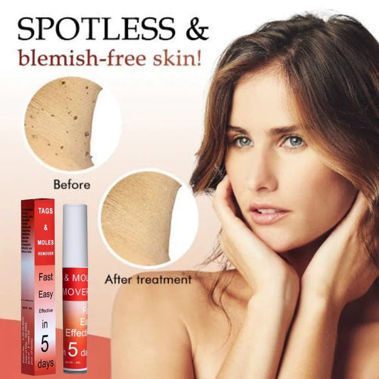 TagMo™ - Tags & Moles Remover (Buy 1 Get 1 Free🔥🔥)